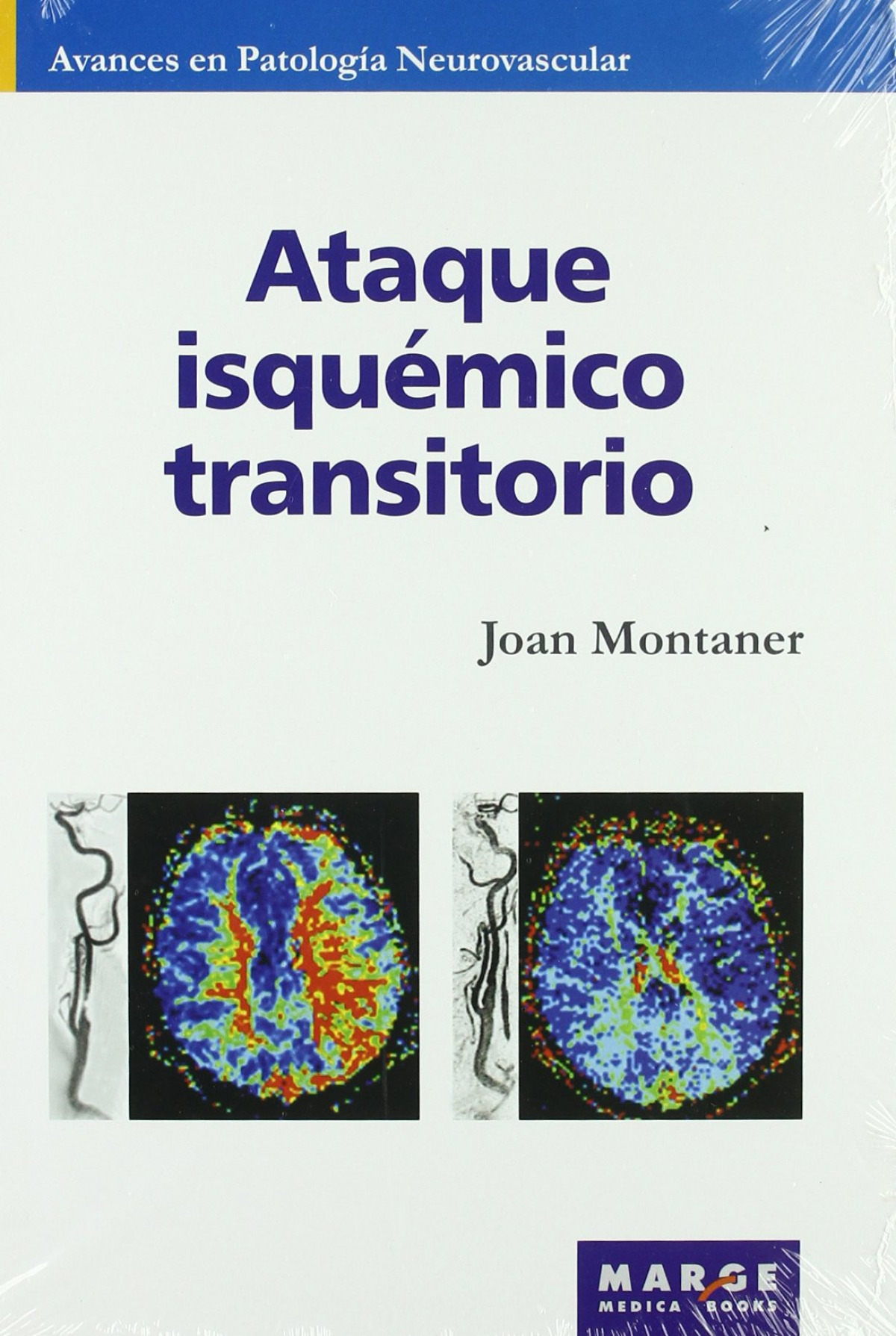 Ataque isquémico transitorio - Montaner, Joan