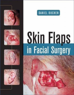 Skin flaps in facial surgery