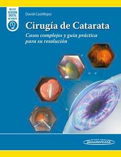 Cirug�a de Catarata